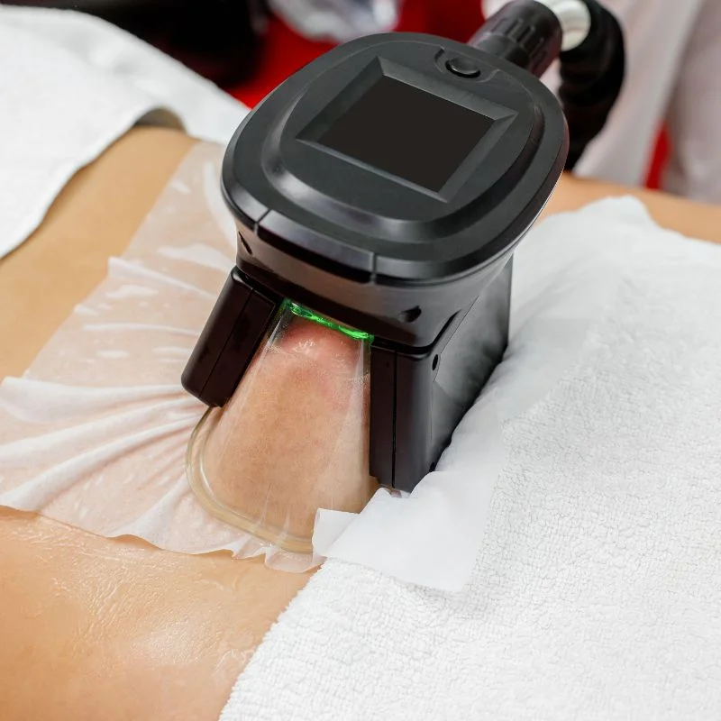 Fat Freezing treatment Sparkbrook